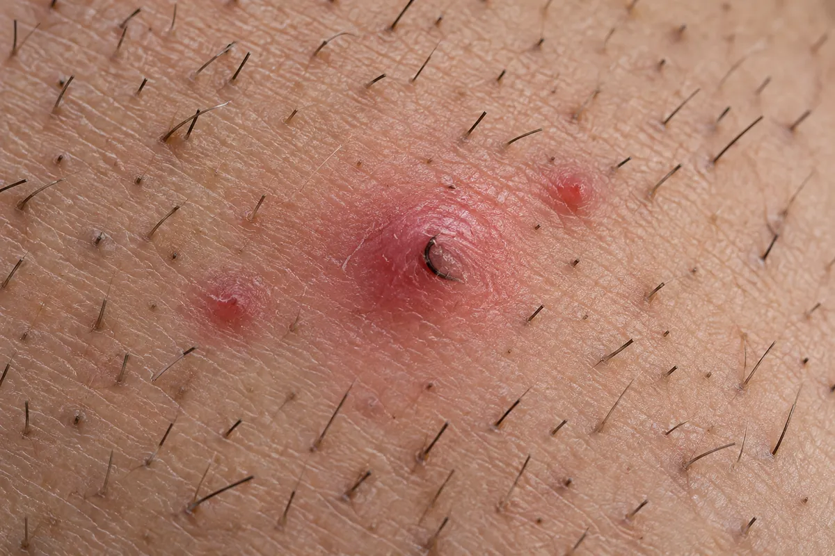 Illustration of an ingrown body hair