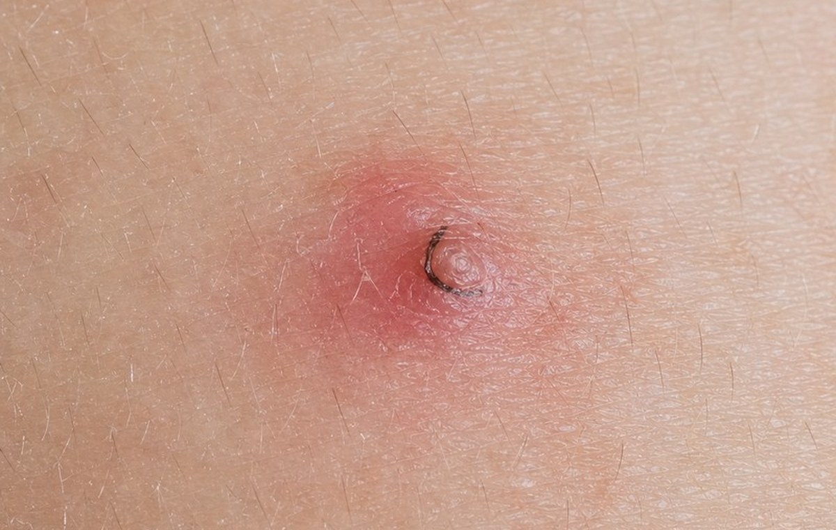Clinical macro photograph of a small raised bump on skin